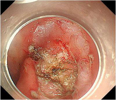Case study of colorectal endometriosis treated with endoscopic submucosal excavation